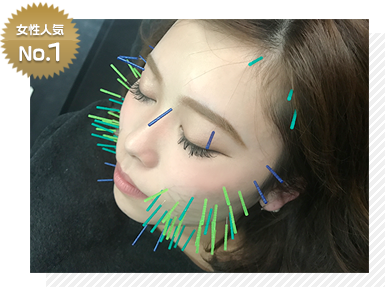 美容鍼の写真